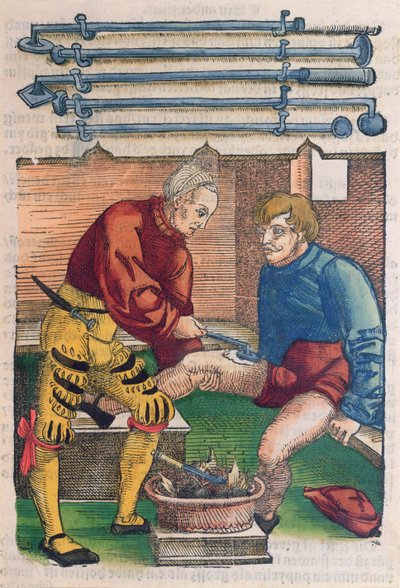 Cauterisation, illustration from 